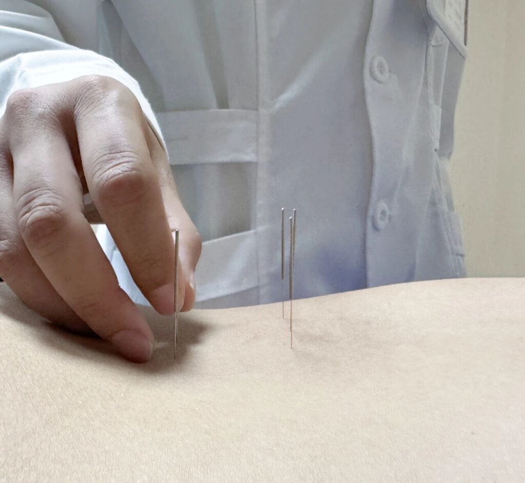 战“痘”失败N+1次，不如试试中西医结合！