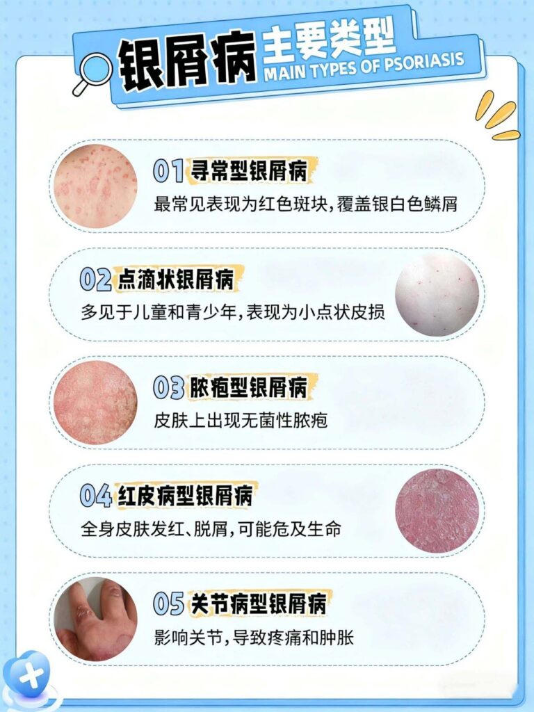 河南变“江南”，牛皮癣患者需要注意这几点