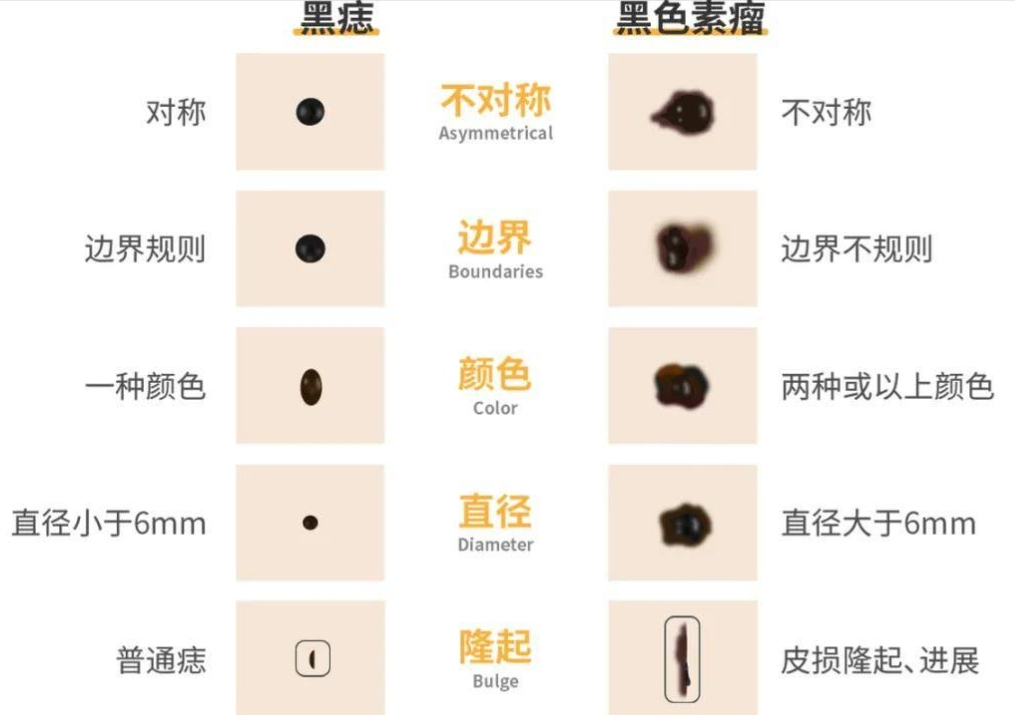 色素痣 | “身上的小黑点”，是否恶变