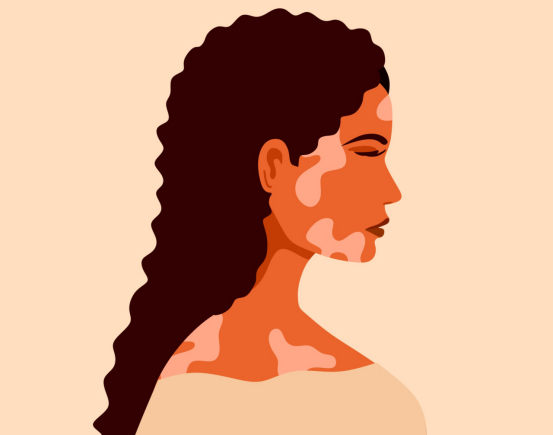 白癜风照光后，发红好还是不发红好？商丘康都中西医结合医院来为你解答