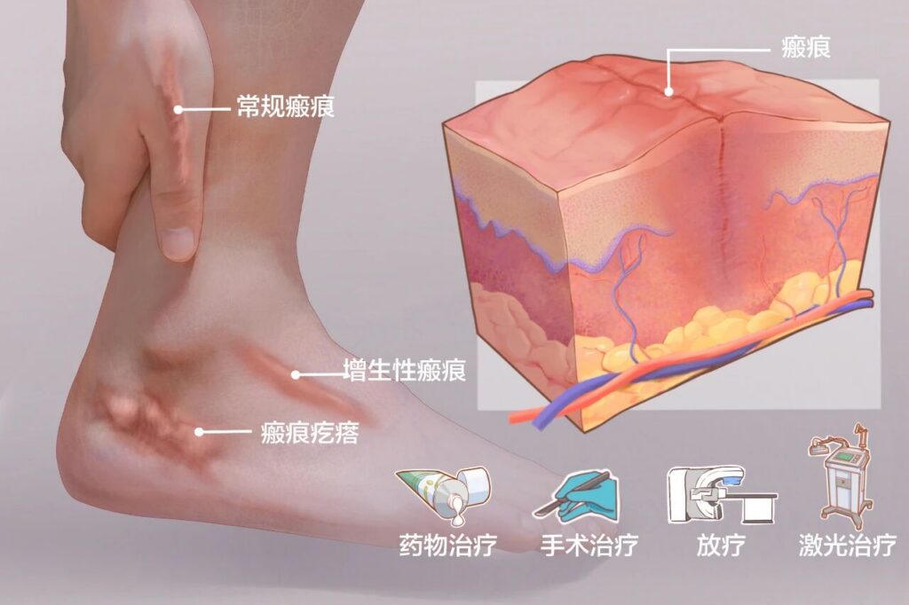 康都小贴士 | 雨季瘢痕增生，你该这样护理