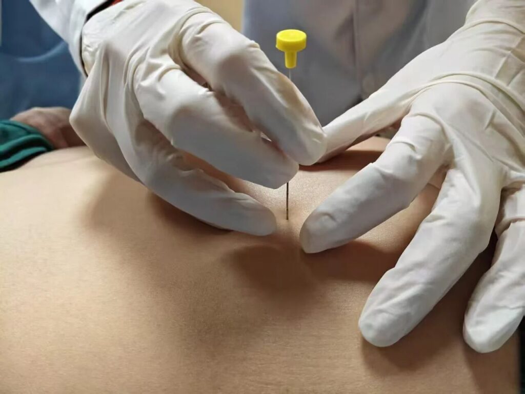 中医埋线减肥：一种传统的瘦身疗法