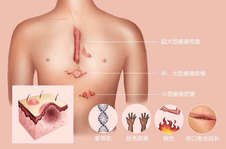 康都小贴士 | 雨季瘢痕增生，你该这样护理