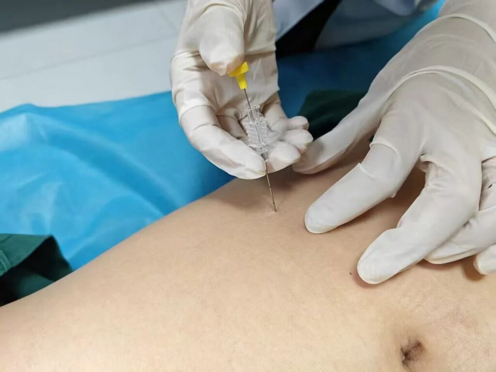 中医埋线减肥：一种传统的瘦身疗法