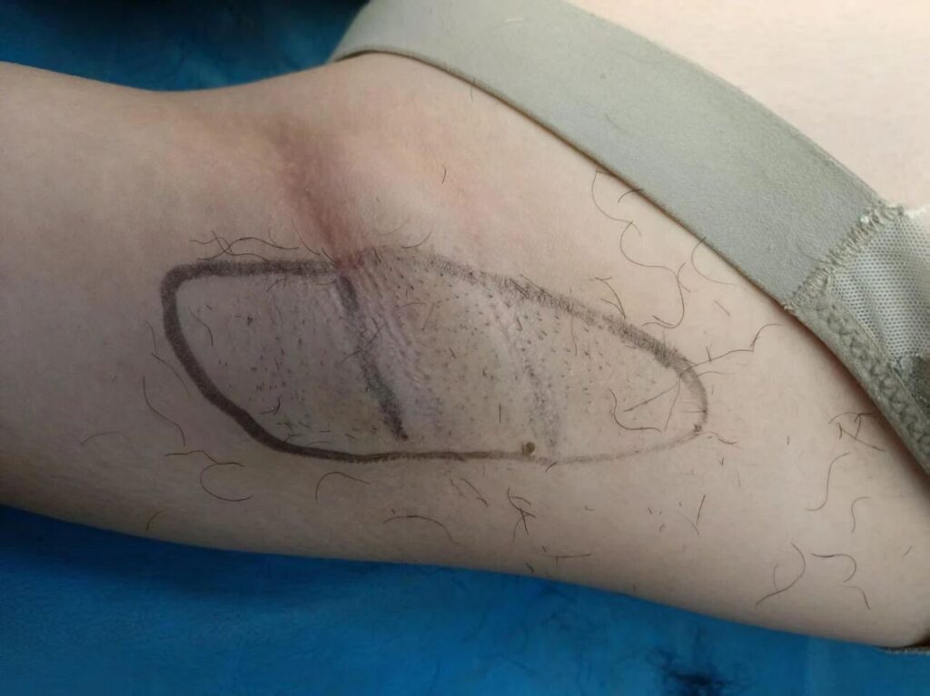 腋臭 | 暑期倒计时，和有味的汗说拜拜