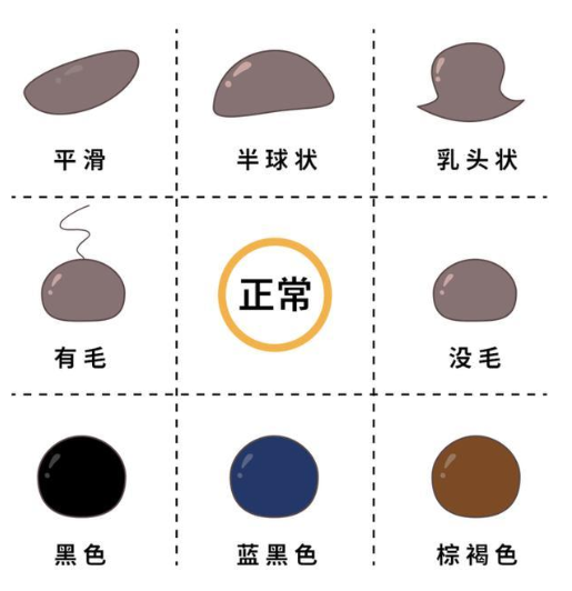 色素痣 | “身上的小黑点”，是否恶变