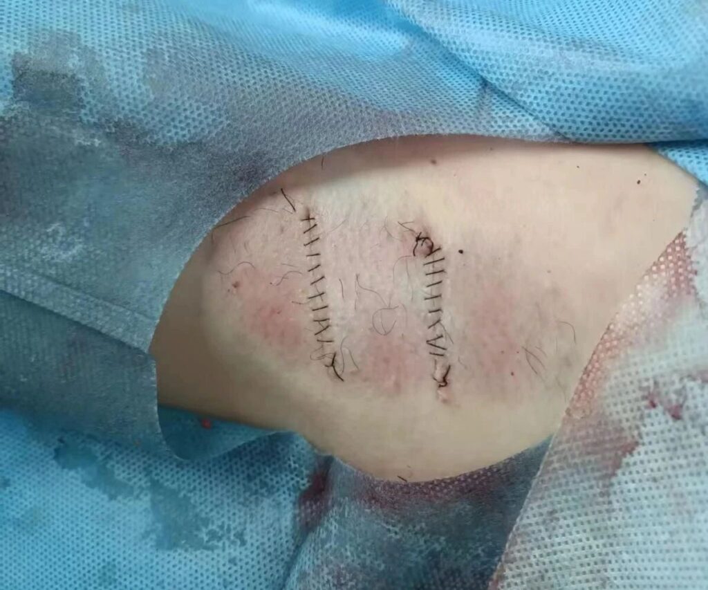 腋臭 | 暑期倒计时，和有味的汗说拜拜