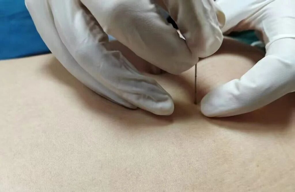 中医埋线减肥：一种传统的瘦身疗法