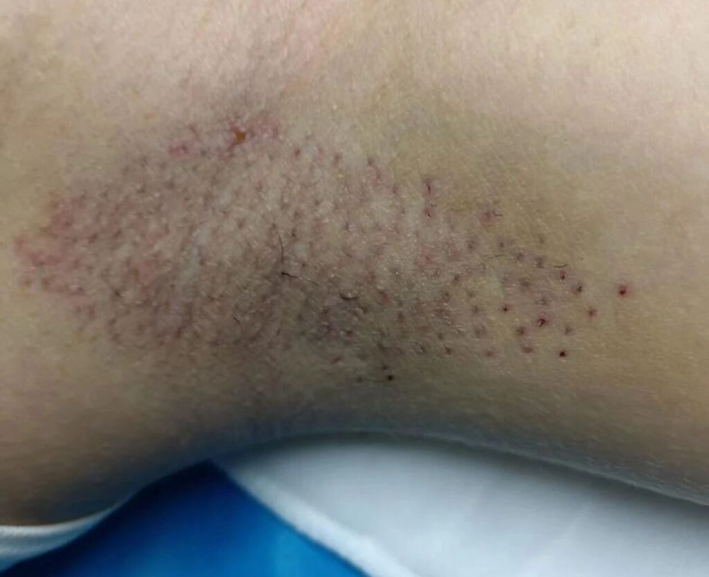 腋臭 | 暑期倒计时，和有味的汗说拜拜