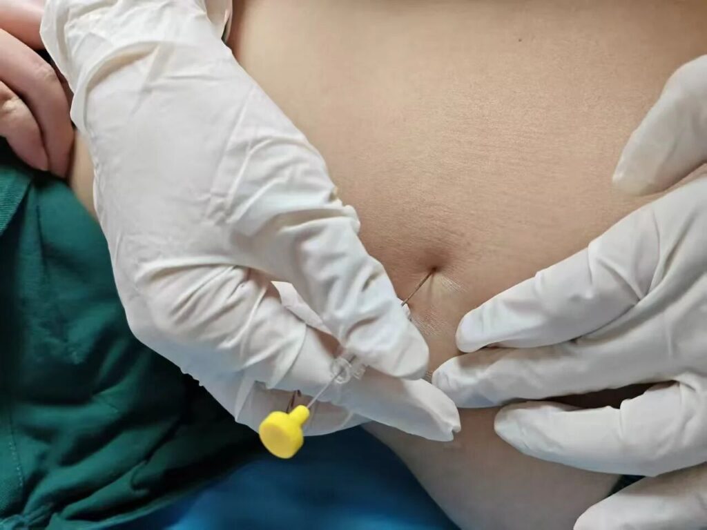 中医埋线减肥：一种传统的瘦身疗法