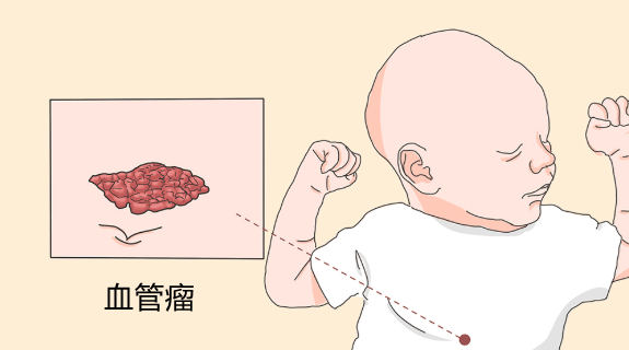 血管瘤并非都能自愈，别盲目等待！