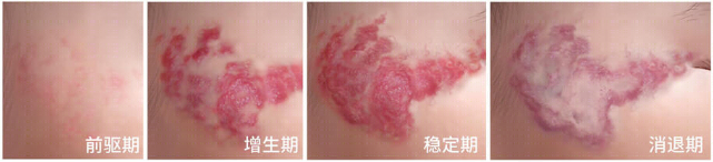 血管瘤并非都能自愈，别盲目等待！