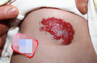 血管瘤并非都能自愈，别盲目等待！